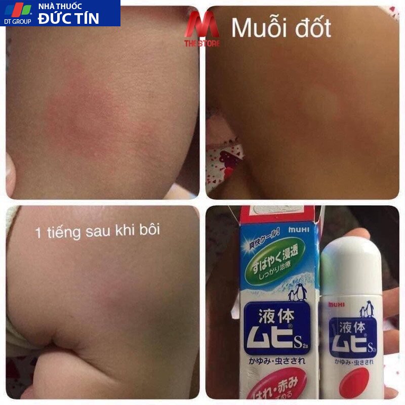 Lăn Bôi Muỗi Đốt Và Côn Trùng Cắn Muhi Nhật Bản 25 lanmuoi4