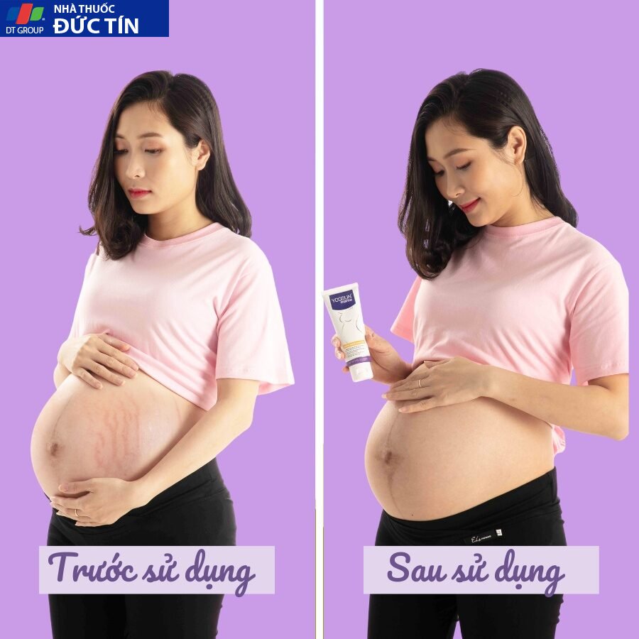Kem Yoosun Mama ngăn ngừa rạn da phục hồi vết rạn phục hồi da dưỡng ẩm làm mềm da - Tuýp 100g 14 tridan6