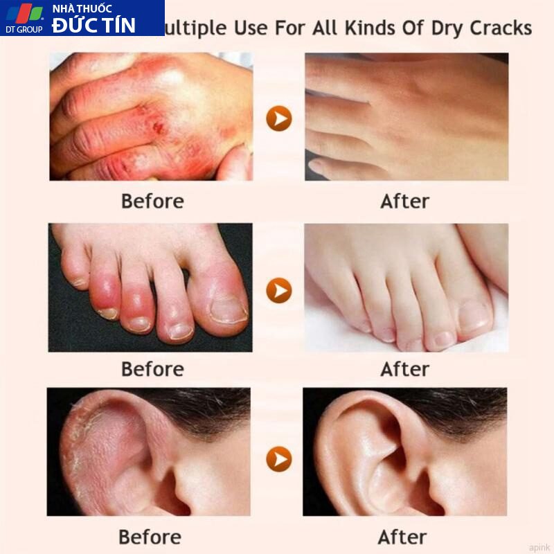 Kem Dưỡng Da Quyên Lara Ngăn Ngừa Da Khô Nẻ,Dưỡng Trắng Da Và Cấp Ẩm Chuyên Sâu Cải Thiện Da Khô Ráp 30ml 22 kemduong7