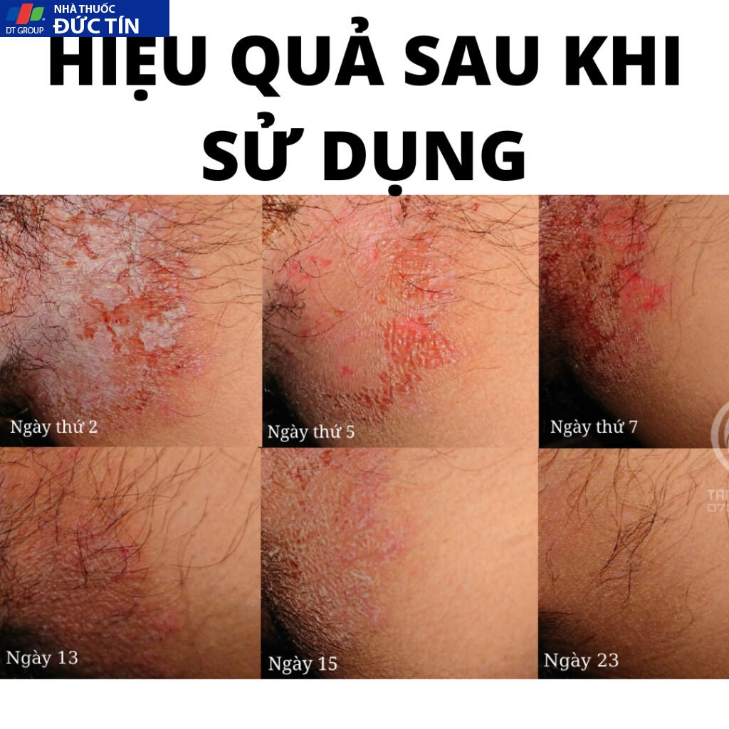Xịt balanitis giúp hỗ trợ loại bỏ sùi mào gà, hạt ngọc dv, gai sinh dục nhanh chóng sau 1 tuần sử dụng 9 (che tên ) 18 balan6