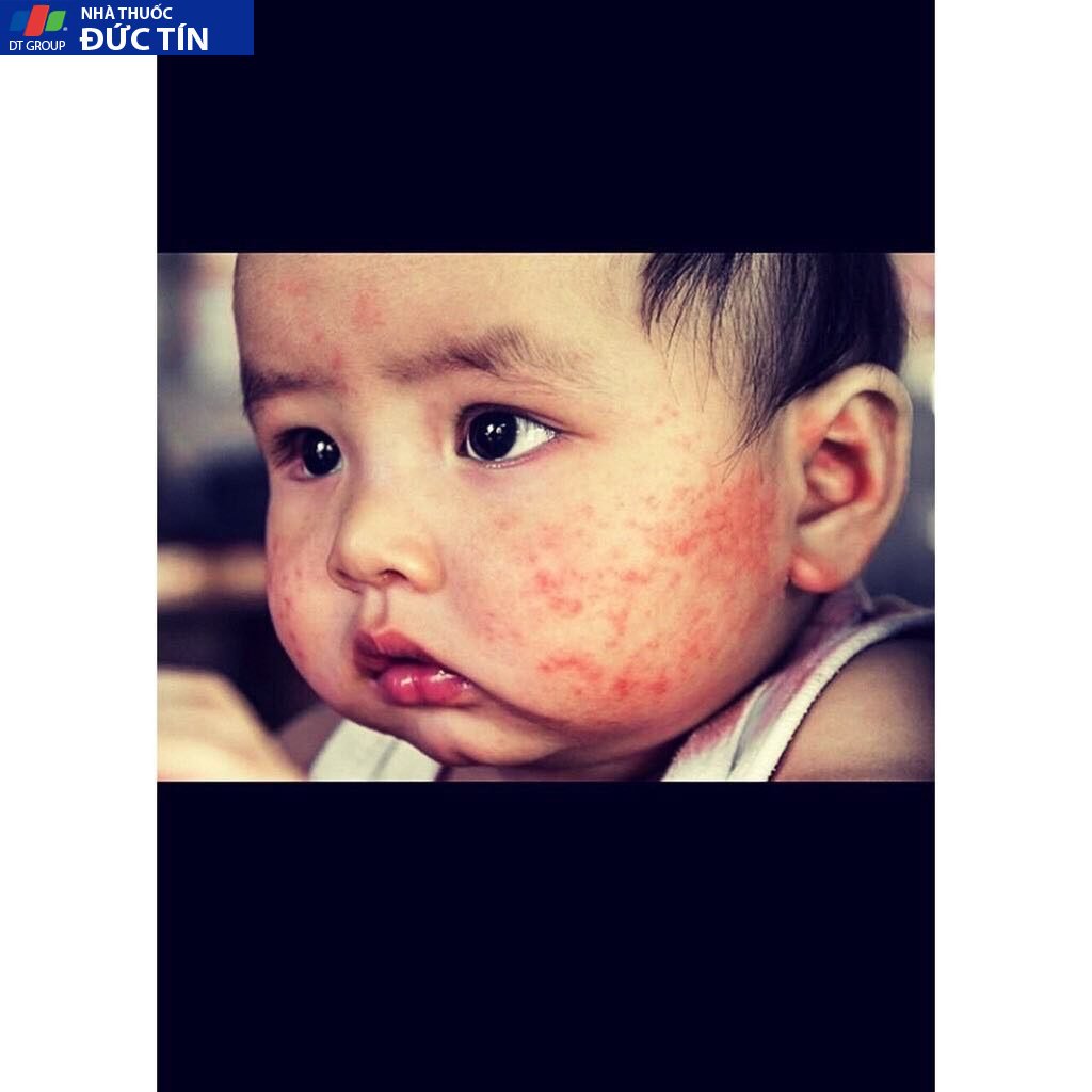 Kem bôi viêm da, hắc lào, mẩn ngứa, hăm tã cho bé và người lớn 10 chanh7