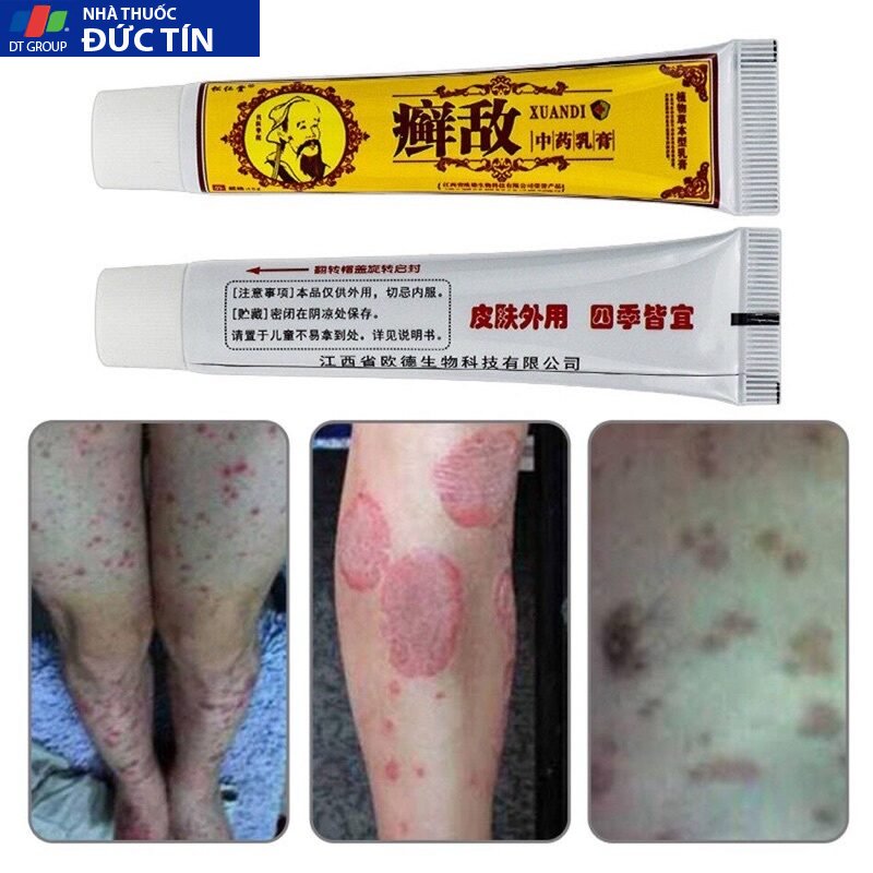 kem bôi, ngoài da, hỗ trợ,nấm ngứa, chàm,tổ đỉa,ghẻ nước,hắc lào ,lăng ben,viêm, loại mới,chính hãng,nội địa TQ 11 gel3