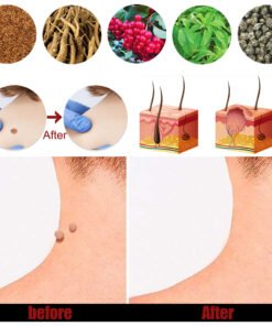 Kem South Moon bôi Nấm Ngứa, Sùi Mào Gà, Mụn Cóc, Mụn Cơm Vùng Kín Nam Nữ, hết ngứa ngay lập tức 10 kemmo5