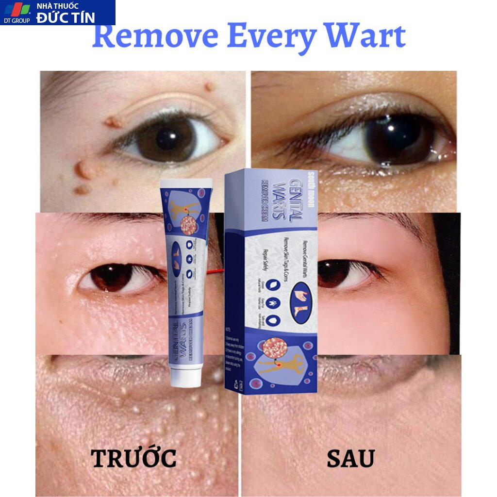 Kem trị mụn cóc,mụn thịt bộ phận sinh dục hiệu quả,loại bỏ mụn cóc thông thường, mụn cơm phẳng Mụn cóc dạng sợi và acumi 26 kemmoc3