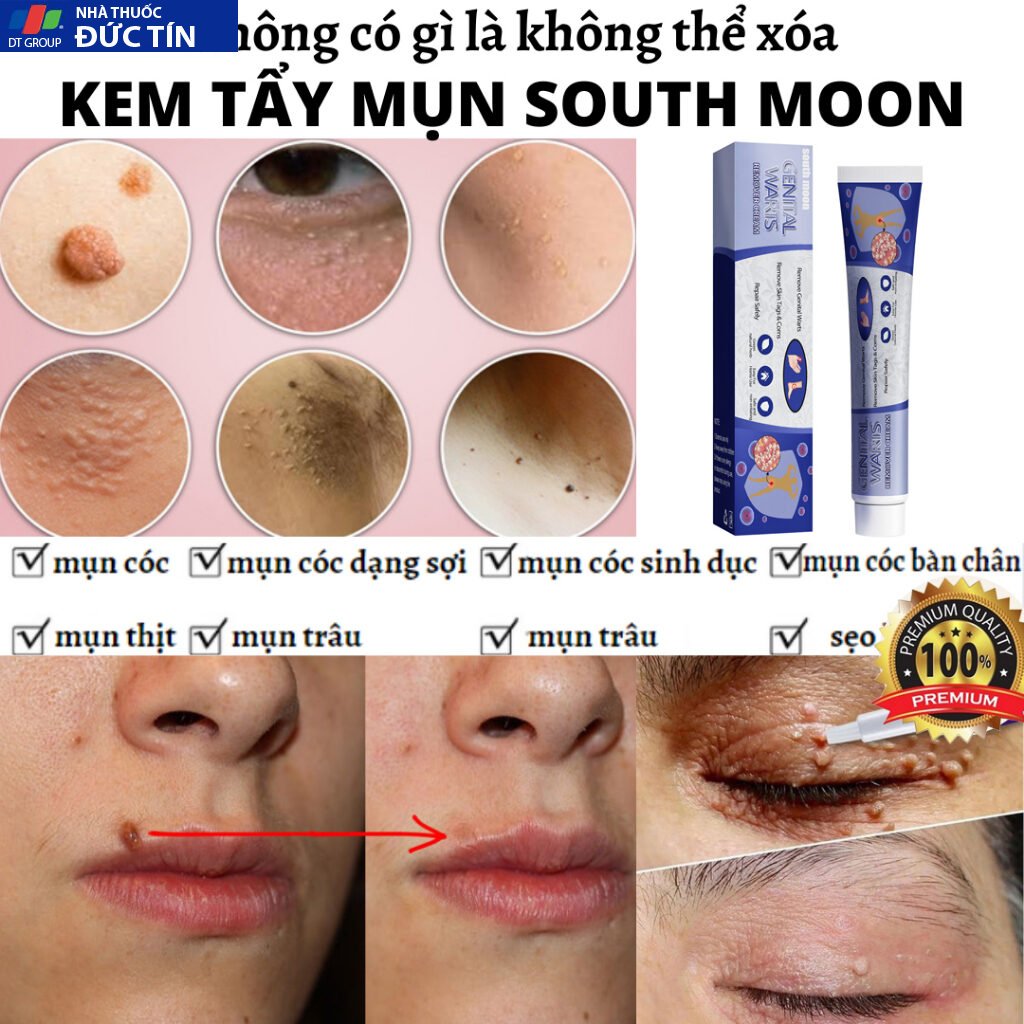 Kem trị mụn cóc,mụn thịt bộ phận sinh dục hiệu quả,loại bỏ mụn cóc thông thường, mụn cơm phẳng Mụn cóc dạng sợi và acumi 25 kemmoc4
