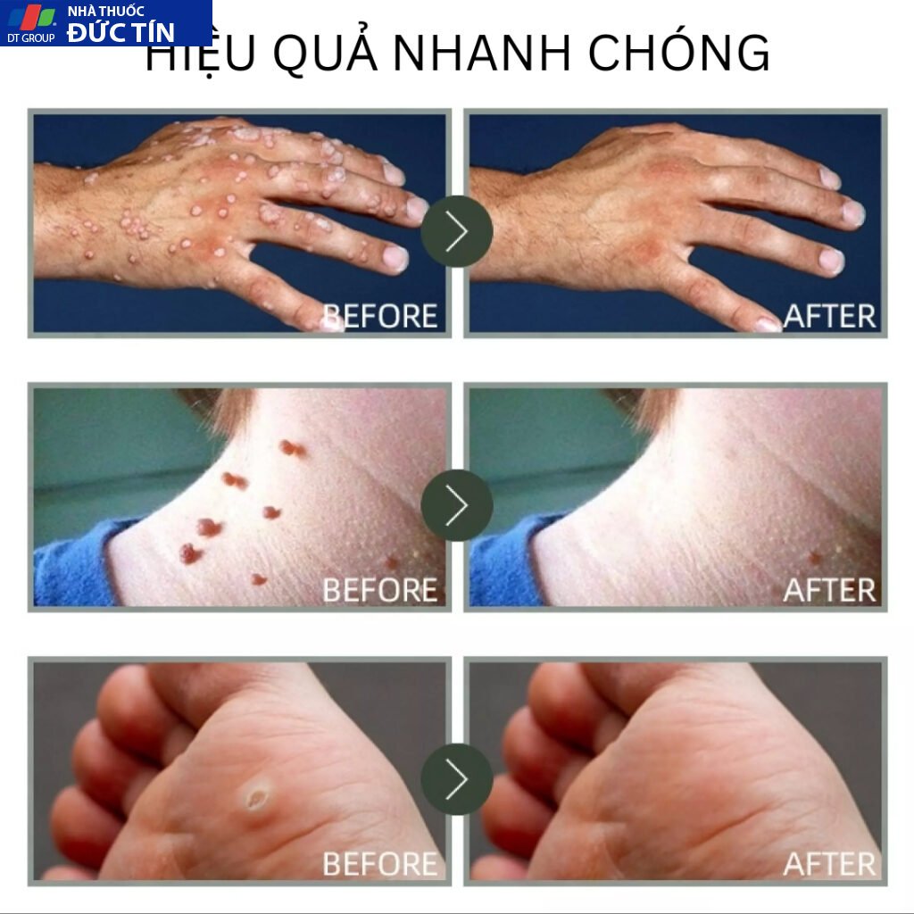 Kem trị mụn cóc,mụn thịt bộ phận sinh dục hiệu quả,loại bỏ mụn cóc thông thường, mụn cơm phẳng Mụn cóc dạng sợi và acumi 24 kemmoc5