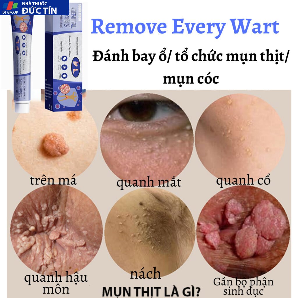 Kem trị mụn cóc,mụn thịt bộ phận sinh dục hiệu quả,loại bỏ mụn cóc thông thường, mụn cơm phẳng Mụn cóc dạng sợi và acumi 23 kemmoc6