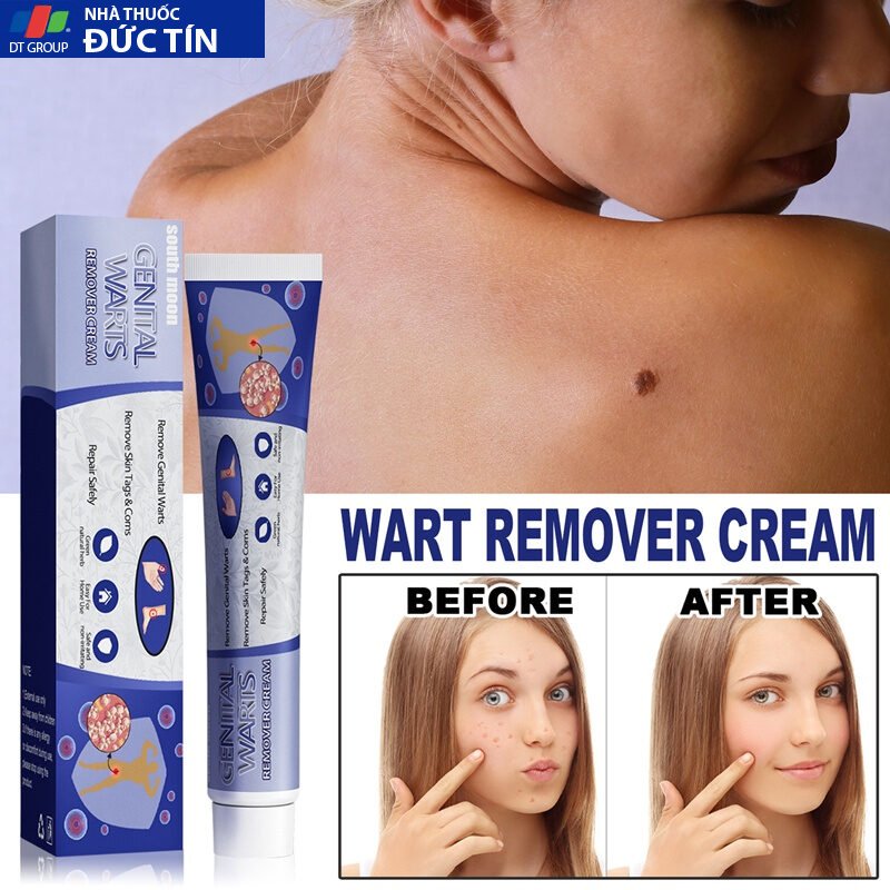 Kem trị mụn cóc,mụn thịt bộ phận sinh dục hiệu quả,loại bỏ mụn cóc thông thường, mụn cơm phẳng Mụn cóc dạng sợi và acumi 21 kemmoc8