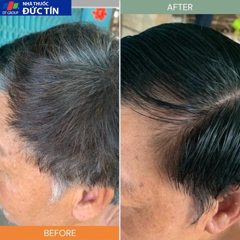 DẦU GỘI PHỦ BẠC LACO ORGANIC NANO NHANH HIỆU QUẢ CHỈ SAU 9 PHÚT KHÔNG LOANG KHÔNG RÁT DA ĐẦU ( CHÍNH HÃNG 21 laco5