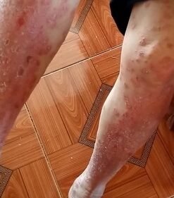 Kem bôi nấm ngứa|mề đay| tổ đỉa| hắc lào| lang ben| vảy nến| á sừng| viem da cơ địa| an toàn cho da| hộp 10Gr 10 nam4