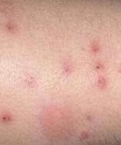 Kem bôi nấm ngứa|mề đay| tổ đỉa| hắc lào| lang ben| vảy nến| á sừng| viem da cơ địa| an toàn cho da| hộp 10Gr 11 nam5