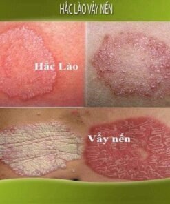 Kem bôi nấm ngứa|mề đay| tổ đỉa| hắc lào| lang ben| vảy nến| á sừng| viem da cơ địa| an toàn cho da| hộp 10Gr 12 nam7