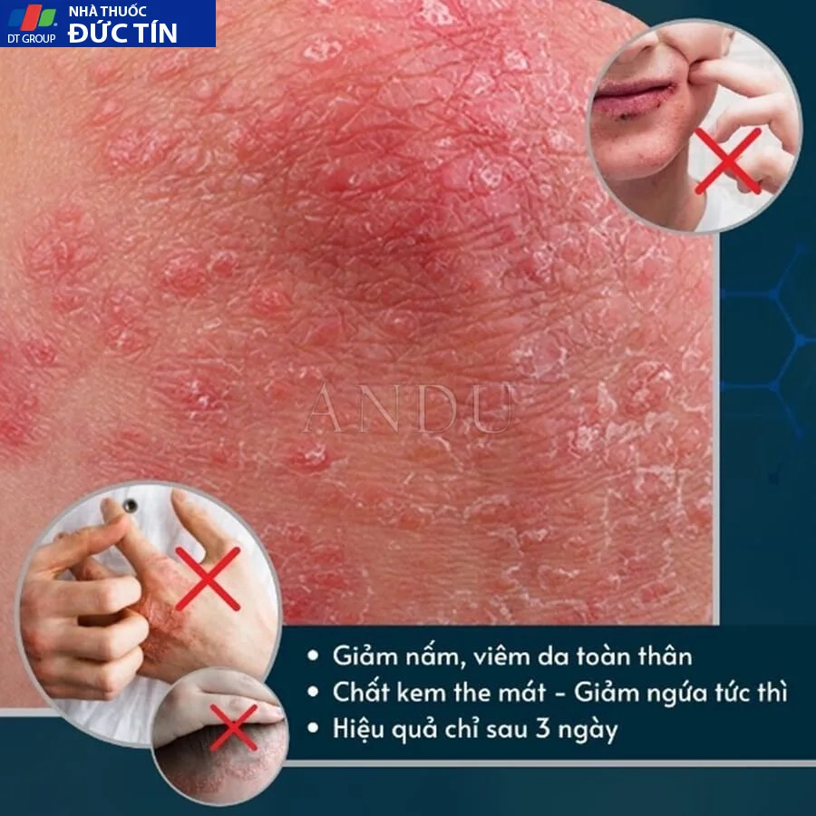 Kem Bôi Viêm Da Cơ Địa NHẬT BẢN Hỗ Trợ Dứt Điểm Lác Đồng Tiền, Nấm Da Đầu, Ghẻ Nước, Á Sừng Cực Kì Hiệu Quả - Ảnh 5