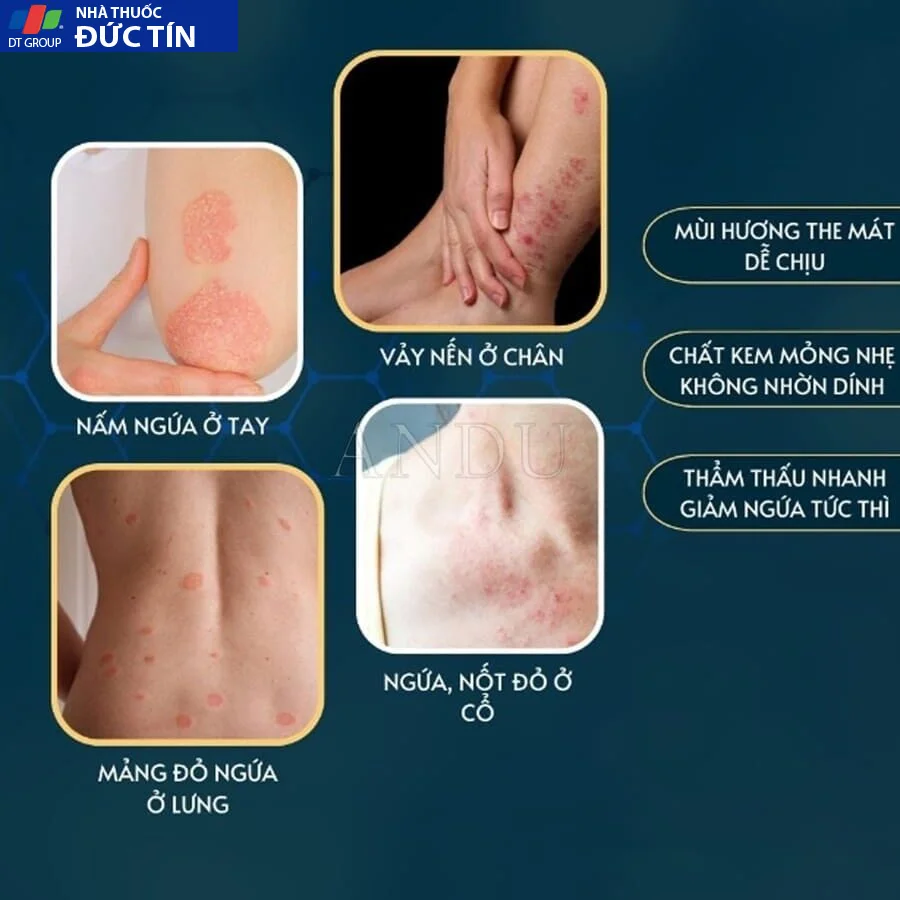 Kem Bôi Viêm Da Cơ Địa NHẬT BẢN Hỗ Trợ Dứt Điểm Lác Đồng Tiền, Nấm Da Đầu, Ghẻ Nước, Á Sừng Cực Kì Hiệu Quả - Ảnh 6