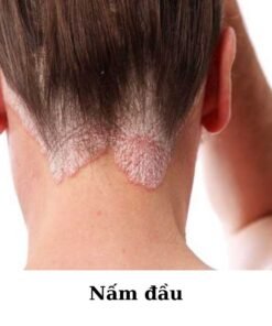 Alternative view of [ ZUDAIFU ] Kem bôi Viêm da cơ địa, Hắc lào, Nấm ngứa đầu, Chàm, Tổ đỉa, Ghẻ nước, Lang ben, Á sừng, Vảy nến, tuýp 15Gr