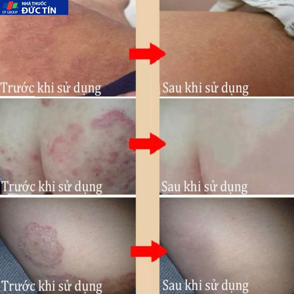 Xịt balanitis hỗ trợ loại bỏ sùi mào gà, gai sinh duc, hạt ngọc vùng kín sau 1 tuần sử dụng ( có che tên ) 15