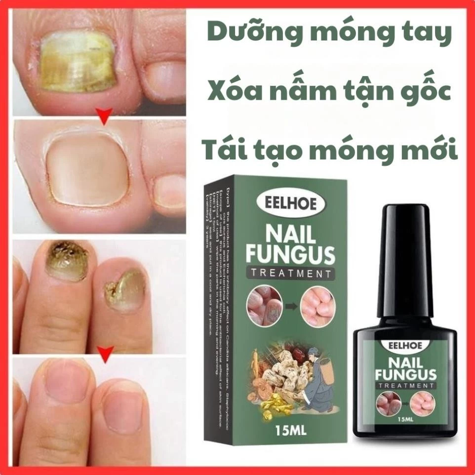 Serum nấm móng tay chân EELHOE 15ml dưỡng cứng hết sạch nấm bọng móng hư khoé nước 23 kemnam1 2