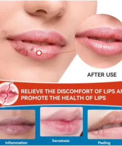 Kem bôi môi hạt FORDYCE SUMIFUN ITALY - dưỡng môi SUMIFUN ITALY cứu tinh cho đôi môi bị FORDYCE 11 sumi4