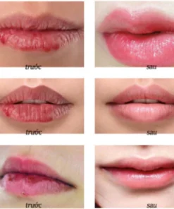 Kem bôi môi hạt FORDYCE SUMIFUN ITALY - dưỡng môi SUMIFUN ITALY cứu tinh cho đôi môi bị FORDYCE 13 sumi6