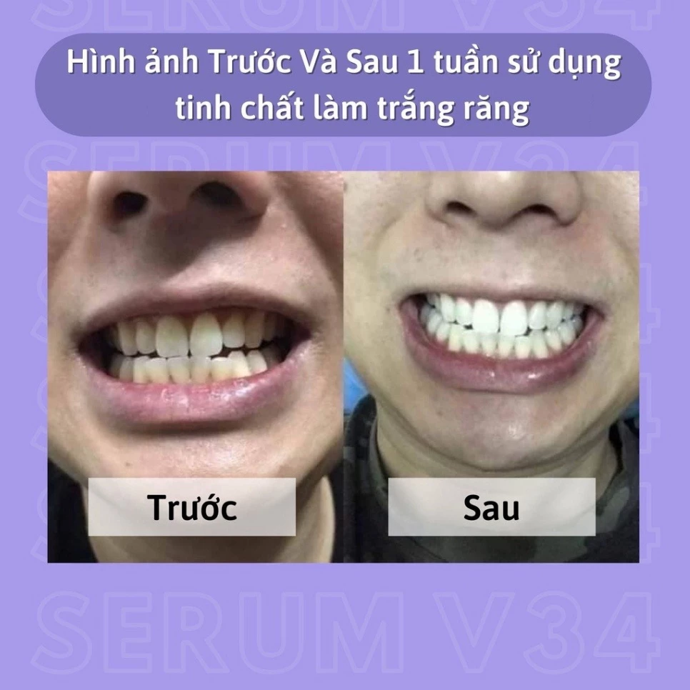 Serum làm trắng răng SmileKit V34, tinh chất làm trắng răng smilekit v34 - 30ml 22 trang8