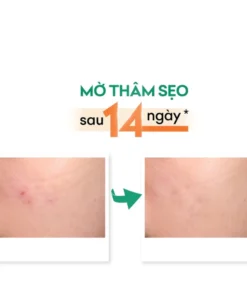 Kem mờ sẹo và thâm dạng gel Acnes Scar Care 12g 9 kemmo3