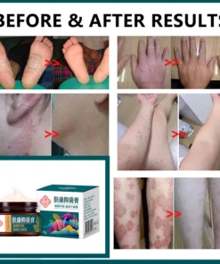 kem bôi nấm ngứa kem bôi ngoài da ghẻ ngứa Kem chống ngứa 30g kem bôi chàm Kem bôi vảy nến 15 kemnam5