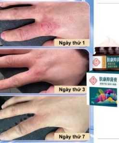 kem bôi nấm ngứa kem bôi ngoài da ghẻ ngứa Kem chống ngứa 30g kem bôi chàm Kem bôi vảy nến 16 kemnam6