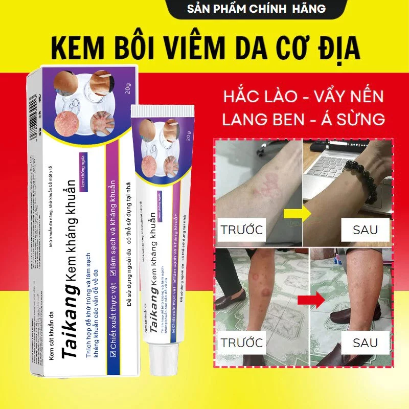 Kem bôi ngứa ngoài da Hỗ trợ dứt điểm Hắc lào,Ghẻ nước,Nấm da đầu,Vảy nến cực kì Hiệu quả Viêm da Giảm ngứa do muỗi đốt 1 Kem bôi ngứa ngoài da Hỗ trợ dứt điểm Hắc lào,Ghẻ nước,Nấm da đầu,Vảy nến cực kì Hiệu quả Viêm da Giảm ngứa do muỗi đốt