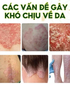 Kem bôi ngứa ngoài da Hỗ trợ dứt điểm Hắc lào,Ghẻ nước,Nấm da đầu,Vảy nến cực kì Hiệu quả Viêm da Giảm ngứa do muỗi đốt 11 kemngua2