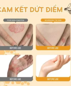 Kem bôi ngứa ngoài da Hỗ trợ dứt điểm Hắc lào,Ghẻ nước,Nấm da đầu,Vảy nến cực kì Hiệu quả Viêm da Giảm ngứa do muỗi đốt 12 kemngua4