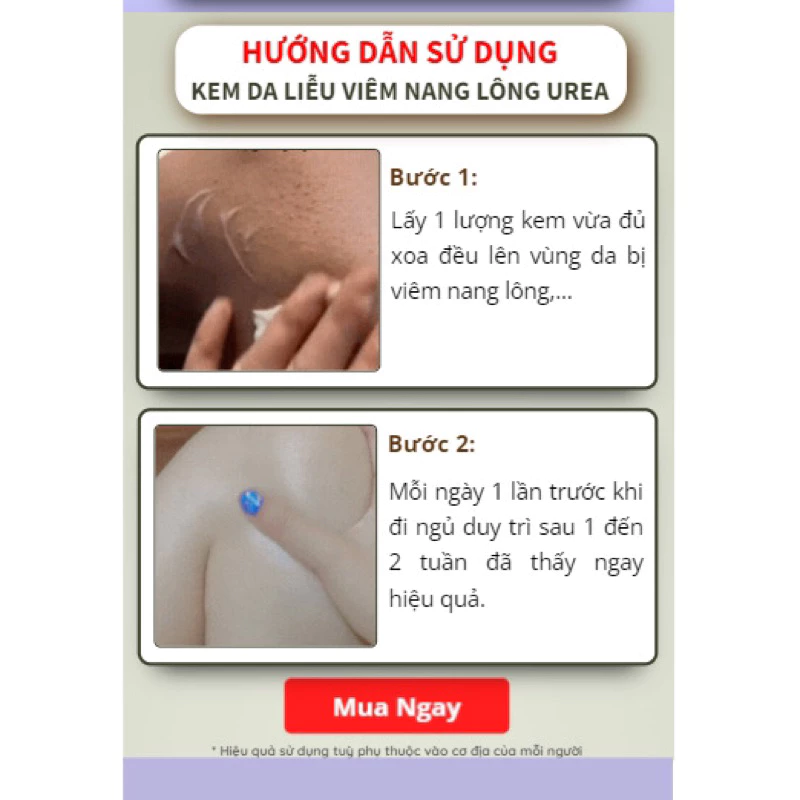 Kem da liễu viêm nang lông UREA - Kem UREA đào thải bít tắc lỗ chân lông, cấp ẩm ngăn ngừa mụn, chăm sóc da khỏe mạnh 10 kemviemda5