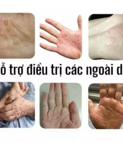 Kem bôi ngứa ngoài da Hỗ trợ dứt điểm Hắc lào,Ghẻ nước,Nấm da đầu,Vảy nến cực kì Hiệu quả Viêm da Giảm ngứa do muỗi đốt 16 kengua3
