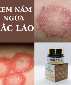 Kem bôi Nấm Ngứa Hắc Lào Ko Tái Lại Nhờ Tặng Bột Rửa Kết Hợp Với Kem Molazin 8 monazin3