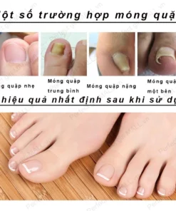 Serum Trị Nấm Móng Tay Chân Hết Sạch Nấm,Móng quặp nặng, Bọng Móng, móng tay móng chân bị cuốn 21 mong3