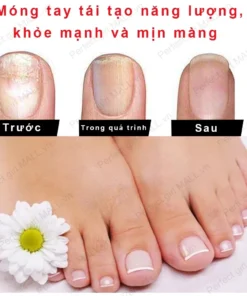 Serum Trị Nấm Móng Tay Chân Hết Sạch Nấm,Móng quặp nặng, Bọng Móng, móng tay móng chân bị cuốn 22 mong4