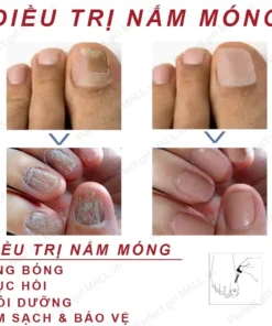 Serum Trị Nấm Móng Tay Chân Hết Sạch Nấm,Móng quặp nặng, Bọng Móng, móng tay móng chân bị cuốn 25 mong7