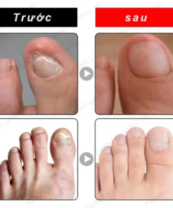 Serum Trị Nấm Móng Tay Chân Hết Sạch Nấm,Móng quặp nặng, Bọng Móng, móng tay móng chân bị cuốn 26 mong8