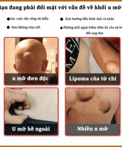 Alternative view of Kem tan u mỡ Kem tan mỡ Kem lipoma 20g Kem tan mỡ chính hãng cho nhiều cục u dưới da đơn lẻ u tuyến