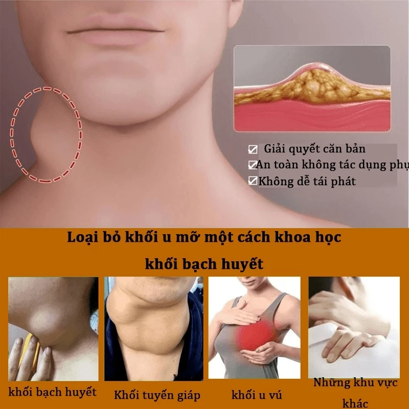 Kem tan u mỡ Kem tan mỡ Kem lipoma 20g Kem tan mỡ chính hãng cho nhiều cục u dưới da đơn lẻ u tuyến 3 Kem tan u mỡ Kem tan mỡ Kem lipoma 20g Kem tan mỡ chính hãng cho nhiều cục u dưới da đơn lẻ u tuyến - Ảnh 3