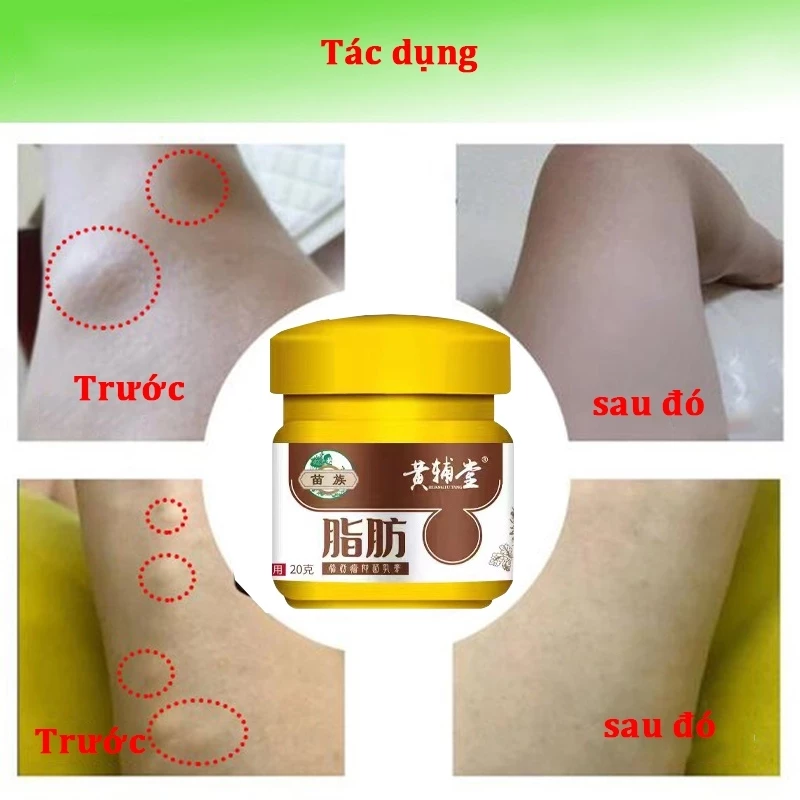 Kem tan u mỡ Kem tan mỡ Kem lipoma 20g Kem tan mỡ chính hãng cho nhiều cục u dưới da đơn lẻ u tuyến 4 Kem tan u mỡ Kem tan mỡ Kem lipoma 20g Kem tan mỡ chính hãng cho nhiều cục u dưới da đơn lẻ u tuyến - Ảnh 4