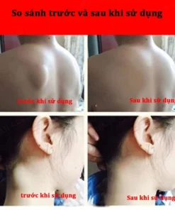 Kem tan u mỡ Kem tan mỡ Kem lipoma 20g Kem tan mỡ chính hãng cho nhiều cục u dưới da đơn lẻ u tuyến 18 tanmo6