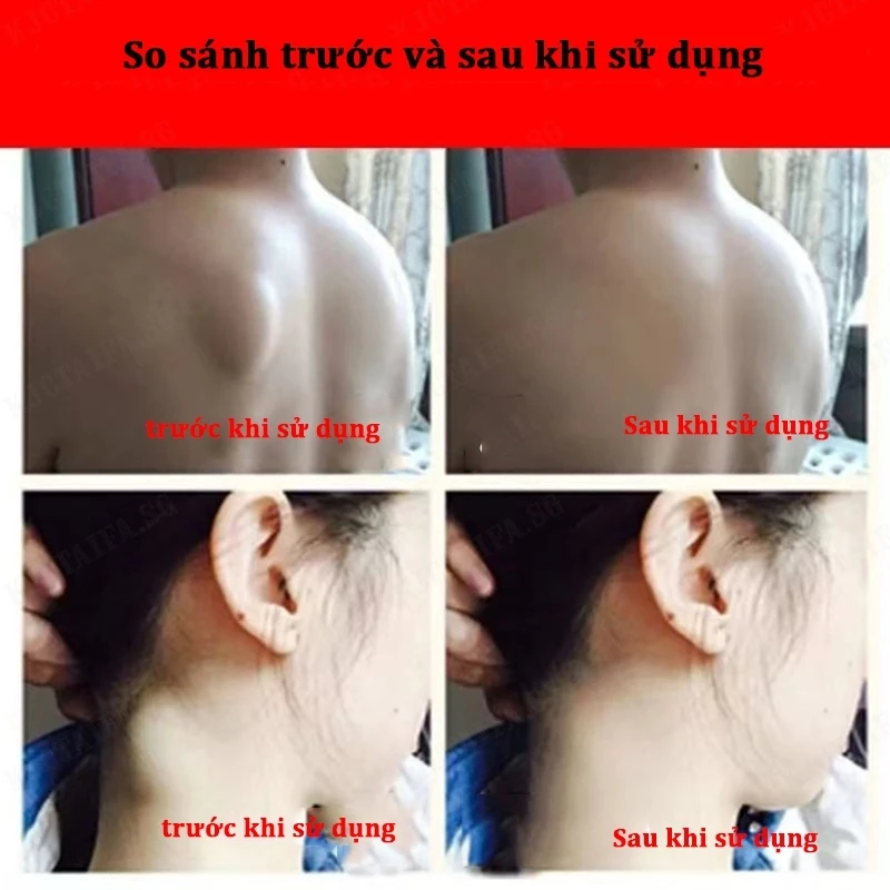 Kem tan u mỡ Kem tan mỡ Kem lipoma 20g Kem tan mỡ chính hãng cho nhiều cục u dưới da đơn lẻ u tuyến 9 Kem tan u mỡ Kem tan mỡ Kem lipoma 20g Kem tan mỡ chính hãng cho nhiều cục u dưới da đơn lẻ u tuyến - Ảnh 9