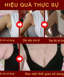 kem tan hạch bạch huyết Giảm viêm bạch huyết giảm cục u dưới da mỡ tiêu tan hạch bạch huyết Giảm Sưng Tấy và mứt 15 bachuy5