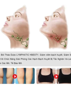 kem tan hạch bạch huyết Giảm viêm bạch huyết giảm cục u dưới da mỡ tiêu tan hạch bạch huyết Giảm Sưng Tấy và mứt 19 bachuye9