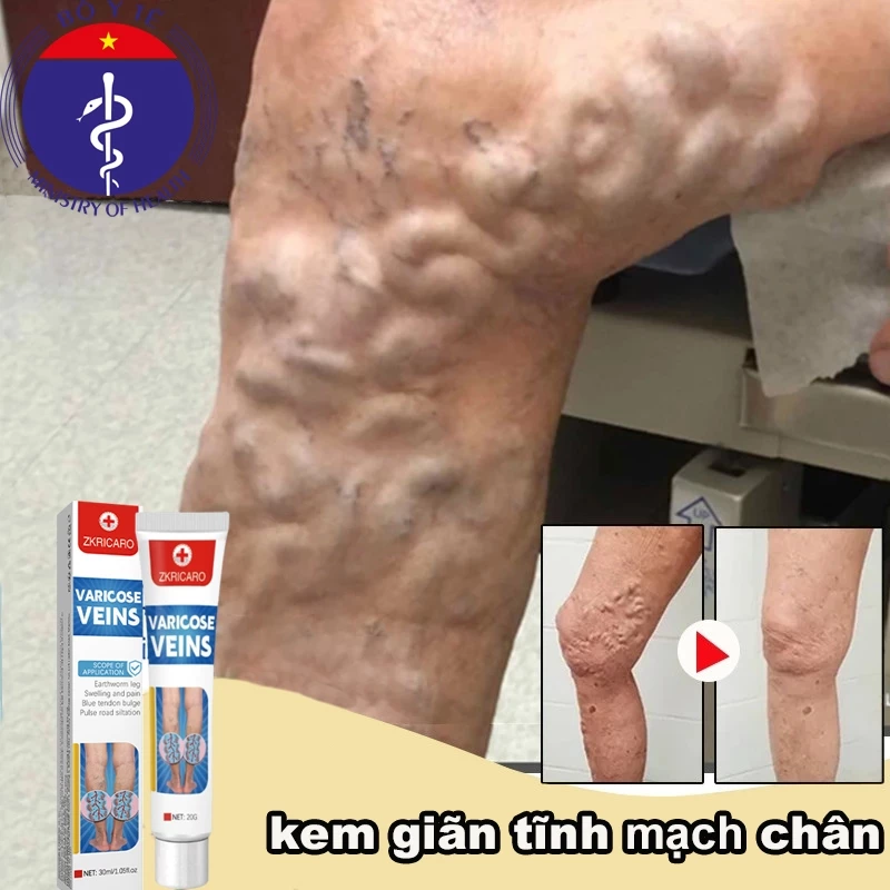 Kem Giãn Tĩnh Mạch Nga Cải Thiện Lưu Thông Máu Giữ Lại Vẻ Đẹp Cho Đôi Chân 26 cogian1