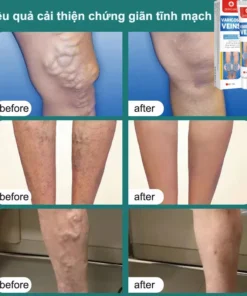 Kem Giãn Tĩnh Mạch Nga Cải Thiện Lưu Thông Máu Giữ Lại Vẻ Đẹp Cho Đôi Chân 14 cogian4