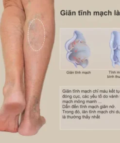 Kem Giãn Tĩnh Mạch Nga Cải Thiện Lưu Thông Máu Giữ Lại Vẻ Đẹp Cho Đôi Chân 16 cogian6