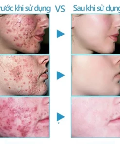 Alternative view of Kem tẩy mụn kem loại bỏ mụn trứng cá [Loại bỏ mụn trong 3 ngày] kem loại bỏ mụn nhanh,làm mờ vết mụn một cách hiệu quả