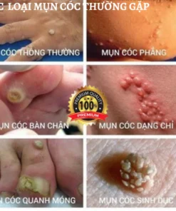 Alternative view of ❤️100% Chính Hãng❤️kem xoá mụn cóc,Tẩy nốt ruồi, mụn thịt, loại bỏ mụn cóc thông thường,mụn đá, mụn cơm,mụn cóc dạng sợi