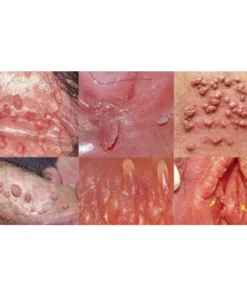 Kem bôi nam khoa Sumifun giúp giảm ngứa vùng kín làm sạch mụn cóc sùi mào gà 20g 17 ngua7